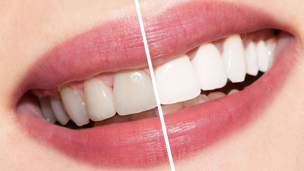 تاثیر رنگ دندان در آرایش عروس